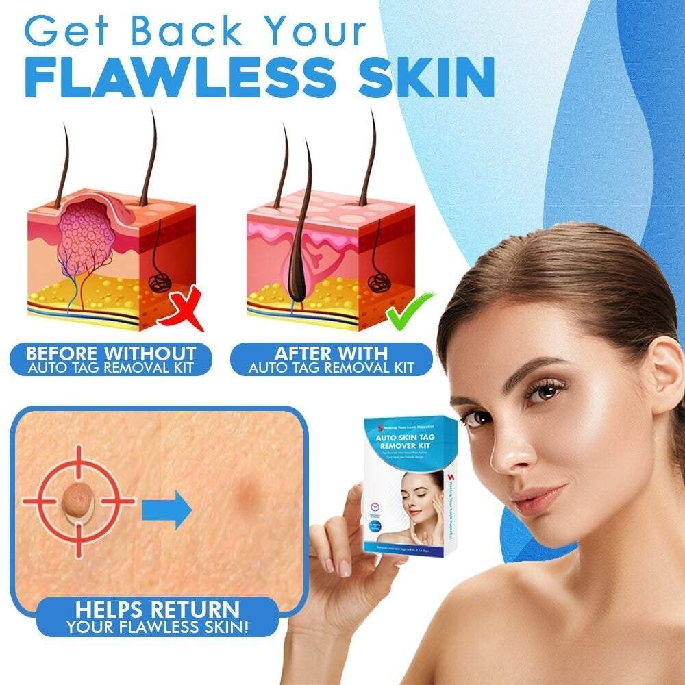 Auto micro skin tag remover