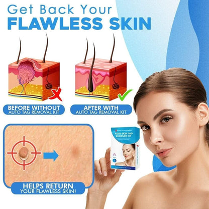 Auto micro skin tag remover