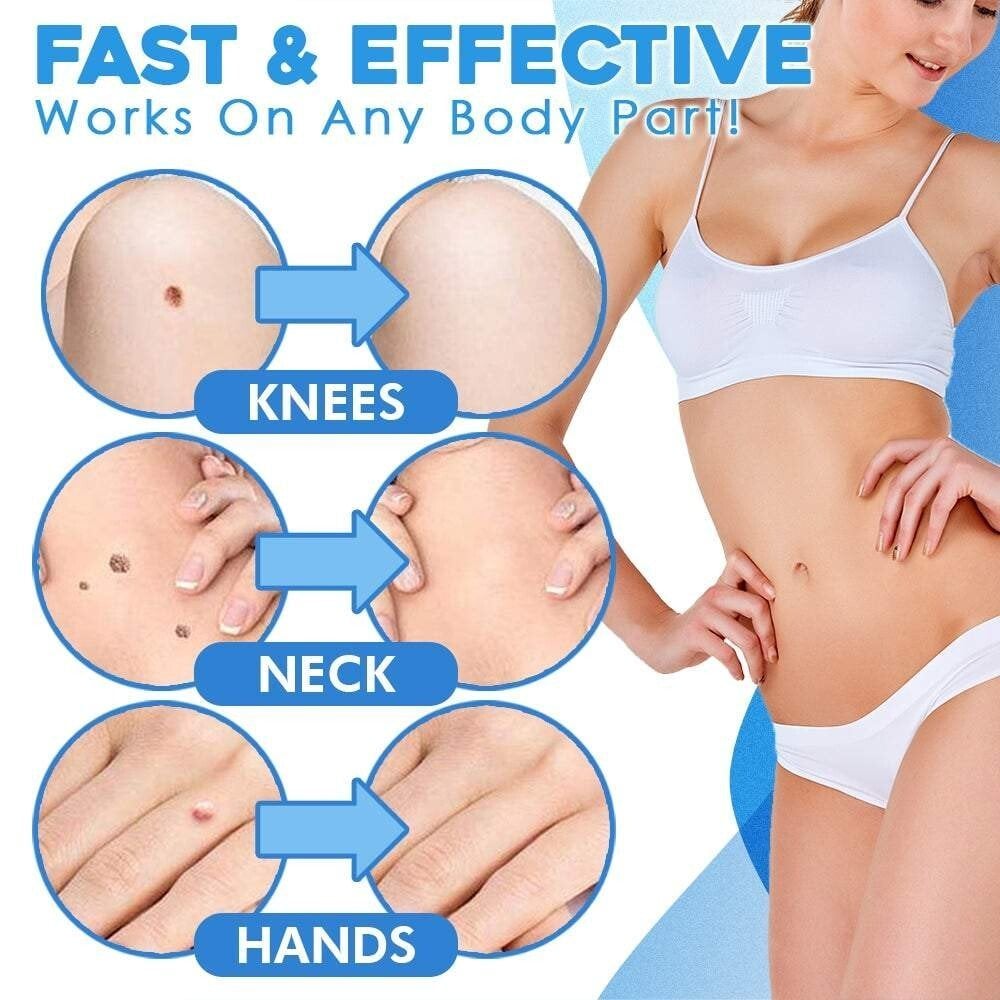 Auto micro skin tag remover