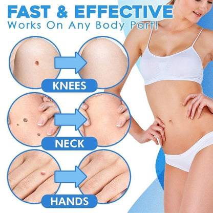 Auto micro skin tag remover