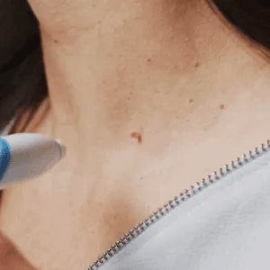 Auto micro skin tag remover
