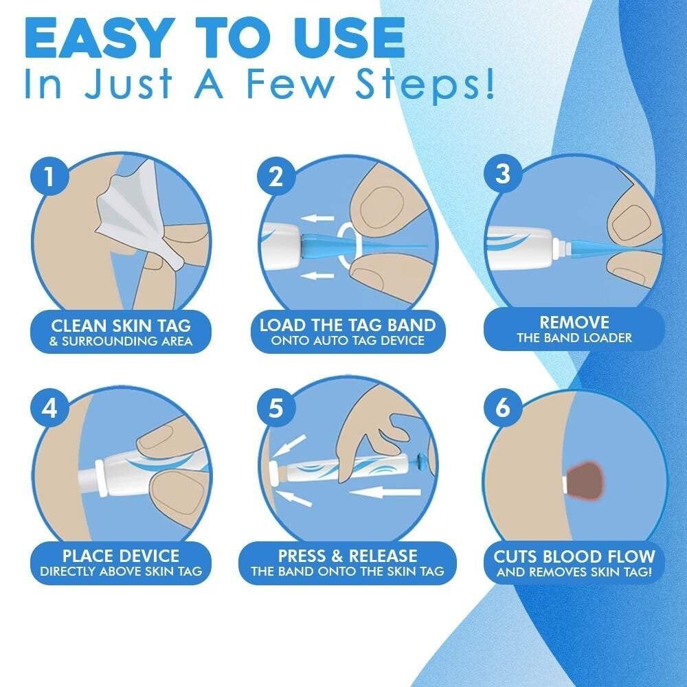 Auto micro skin tag remover