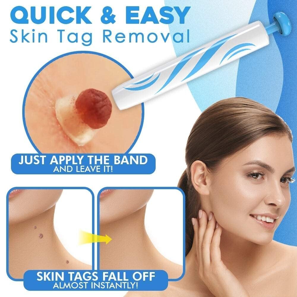 Auto micro skin tag remover
